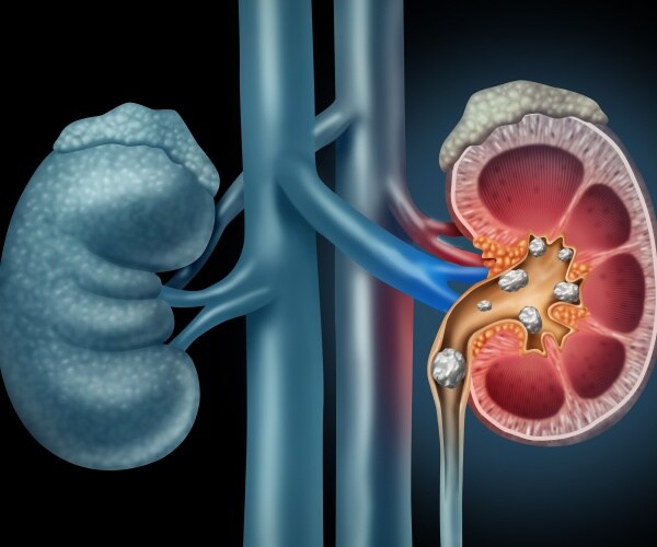 illustration of stones in kidney