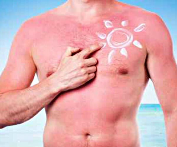 8 Ways to Soothe Sunburns Naturally