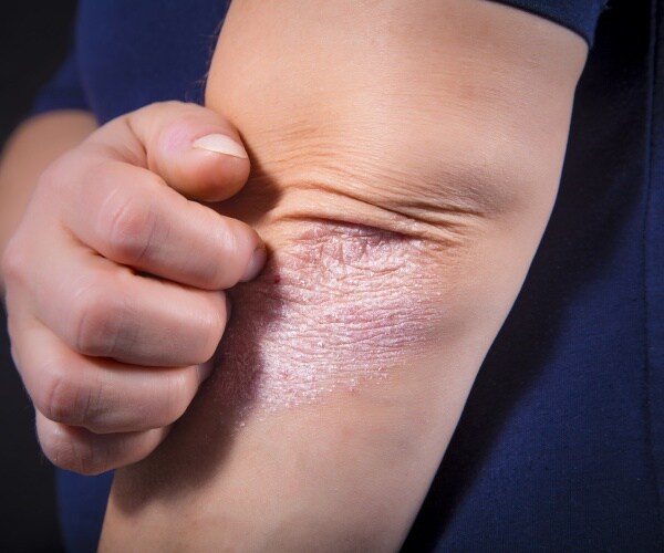 elbow with psoriasis