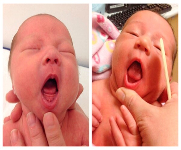 photos of baby with tongue-tie