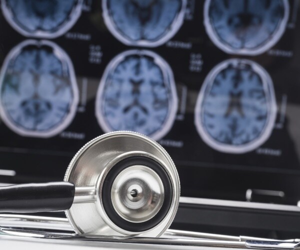 x-ray of brains showing Alzheimer's disease, stethoscope