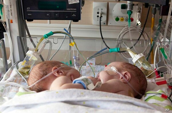 Conjoined Twins Successfully Separated; Shared Liver, Intestines