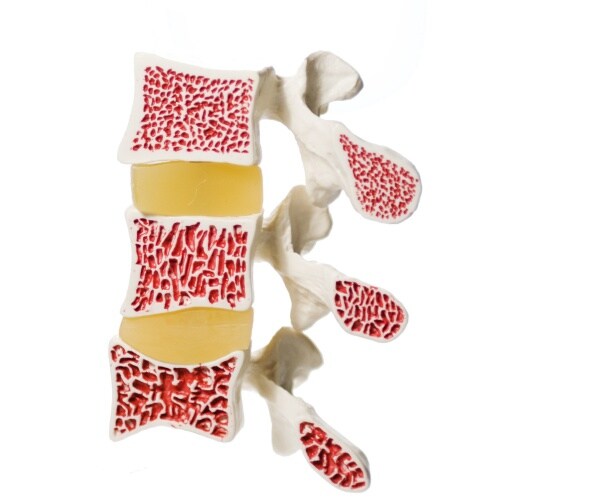 illustrated model of osteoporosis