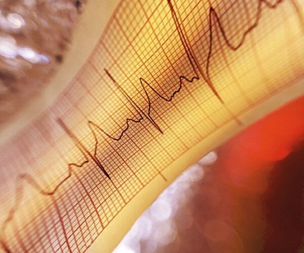 atrial fibrillation illustration