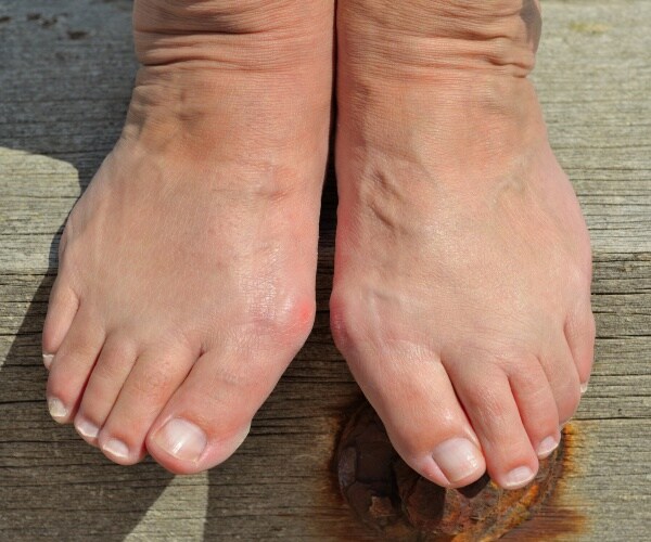 close up of two feet with bunions