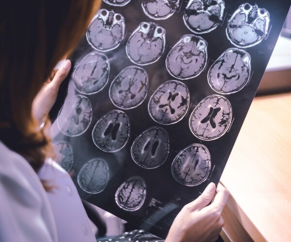 physician looking at MRI of brain with dementia