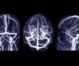 Eating Disorders in Young Linked to Brain Variation